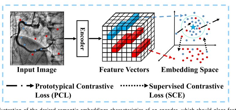 MSA-UNet3+: Multi-Scale Attention UNet3+ with New Supervised Prototypical Contrastive Loss for Coronary DSA Image Segmentation Figure 1