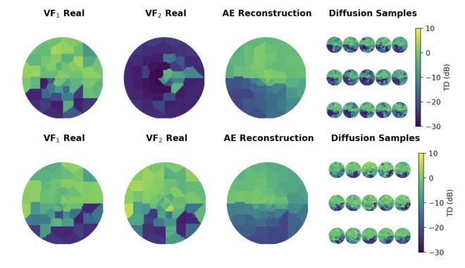 Beyond Point Estimates for Glaucoma Visual Field Forecasting with Diffusion Models Figure 1
