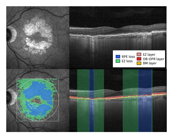 Fully Automated High-Precision Segmentation of Retinal Atrophy and Ellipsoid Zone Thickness in OCT: A Reliable Tool for Real-World GA Monitoring Figure 1