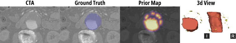 Trust the Prior (or Not): Uncertainty-Aware Abdominal Aortic Aneurysm Segmentation Figure 1