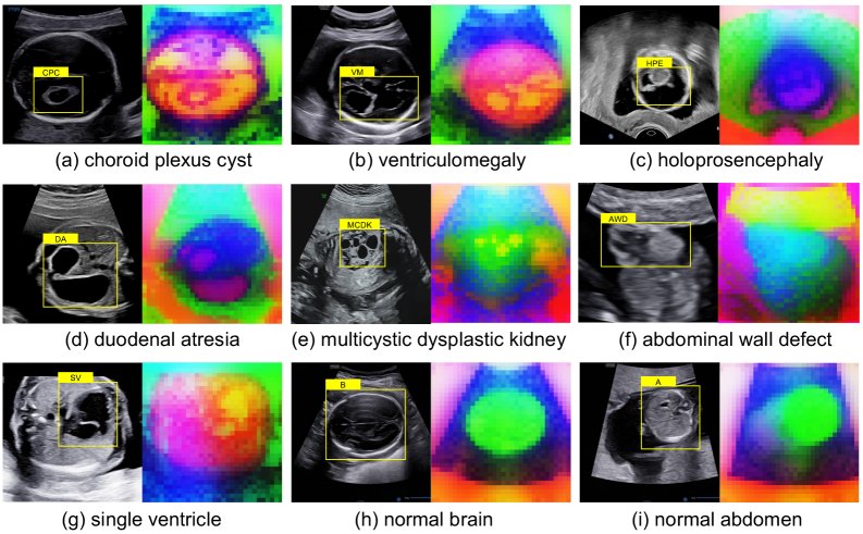 Prototype Memory-Guided Training-Free Anomaly Classification and Localization in Prenatal Ultrasound Figure 1