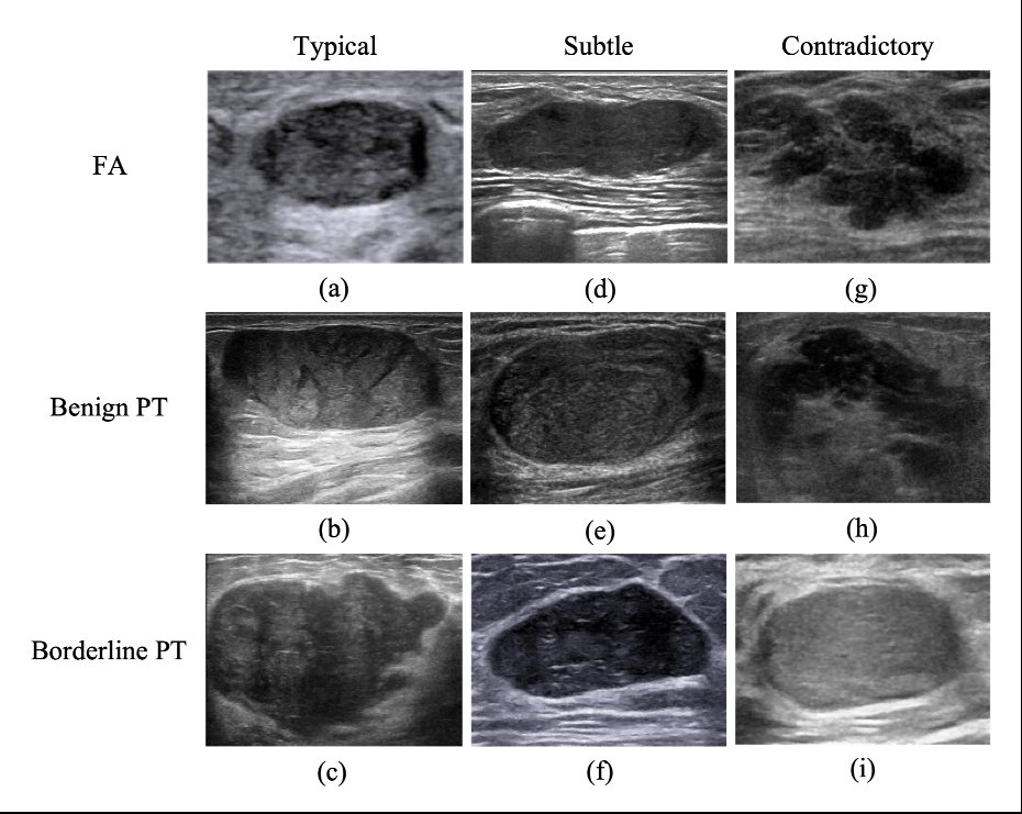 Multimodal Fusion for Fine-Grained Classification of Breast Fibroadenoma and Phyllodes Tumors Figure 1