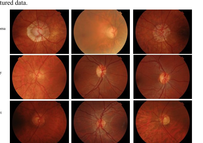 An Automated Multimodal Glaucoma Detection Framework Using ViT and a Stacking-Based Ensemble Figure 1