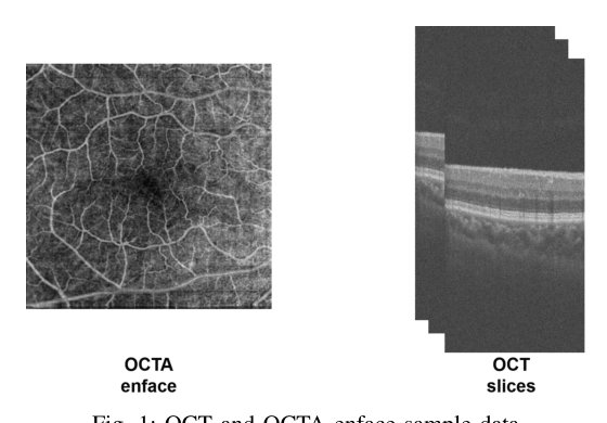 Cross-Modal Fusion of OCT and OCT angiography enface for Improved Diagnostics of Diabetic Retinopathy Figure 1