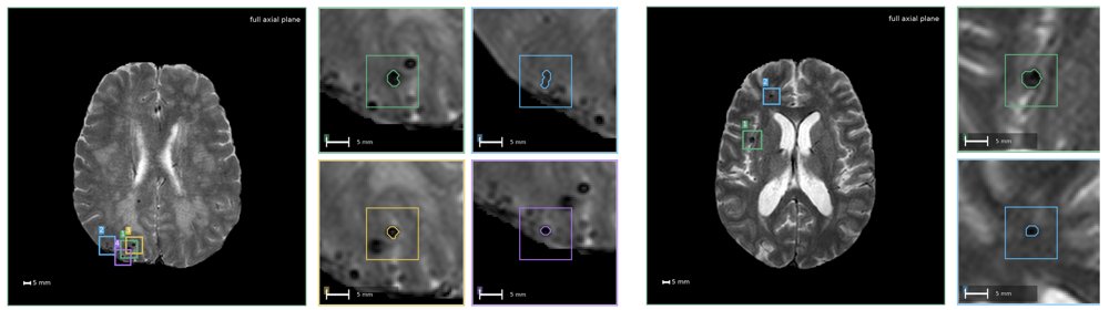 CenSynCMB: Centre Maps and Physics-Guided Synthesis for Microbleed Detection Figure 1